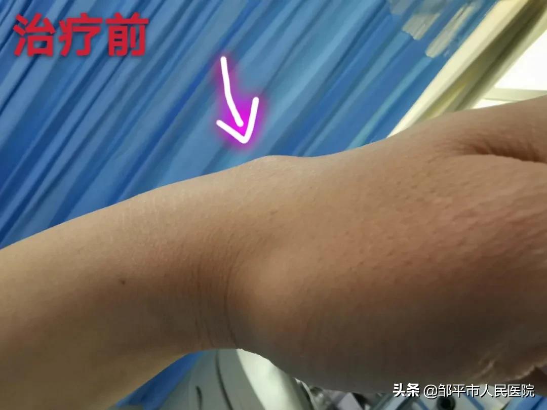 针灸三次就有效果还需要再扎吗,针灸治疗皮下囊肿