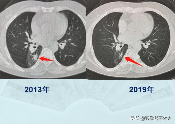 癌症晚期肺转移还能活多久,肺癌症晚期能有必要化疗吗