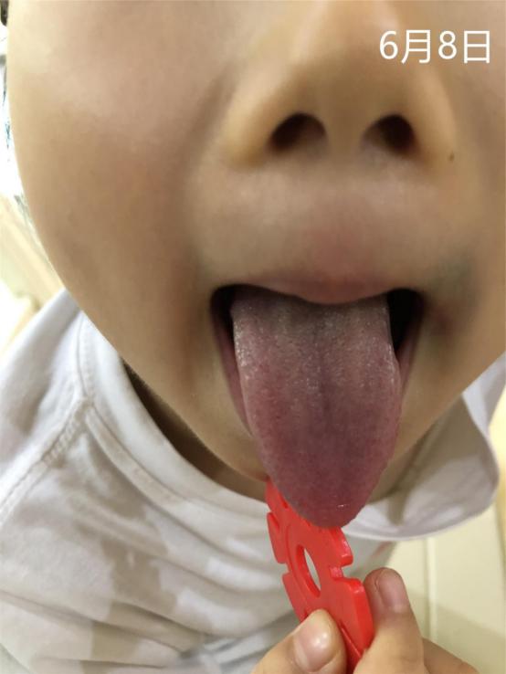 小孩胃积食口臭磨牙怎么办,孩子磨牙是积食还是胃热