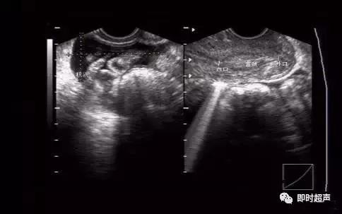 阴部超声检查什么时候做,妇科阴式超声检查方法