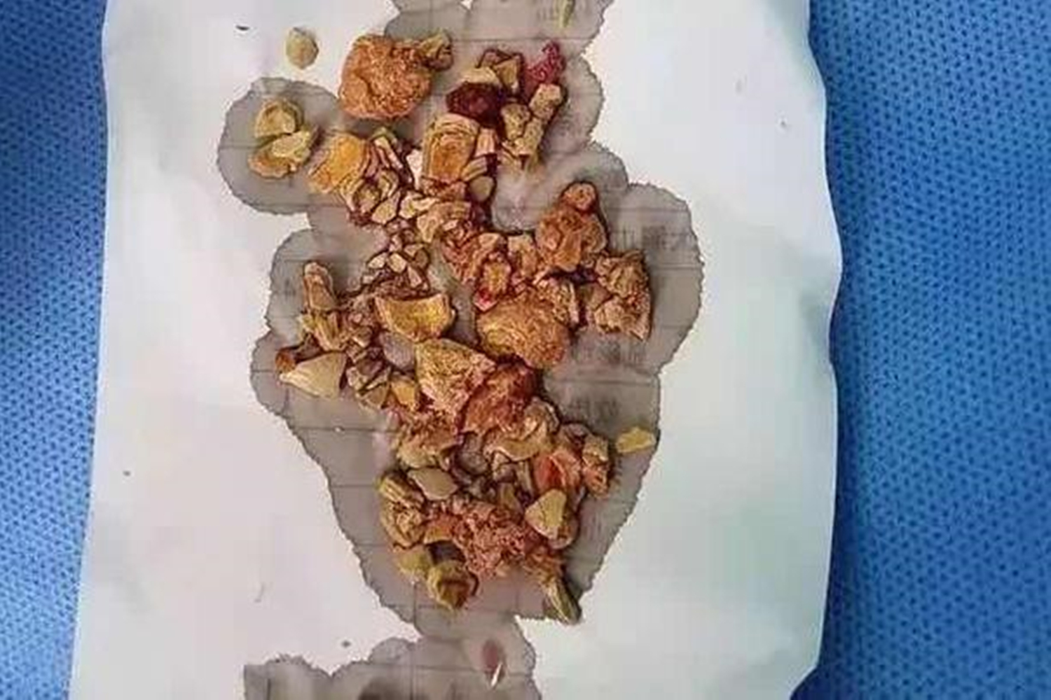 宝宝过早吃辅食会得结石,宝宝有点结石哪一种辅食才能吃