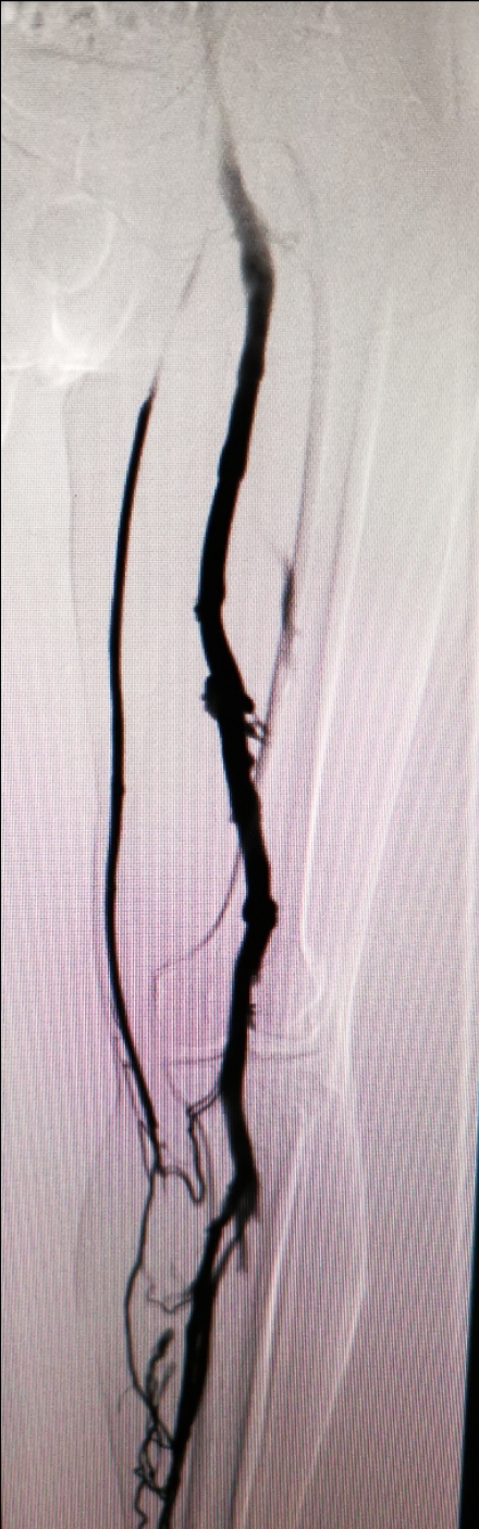 小腿发痒要警惕静脉曲张,小腿深静脉血栓的治疗方法是什么