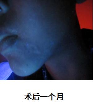 白癜风一年没扩散还一直在恢复,三个月可以治愈白癜风吗