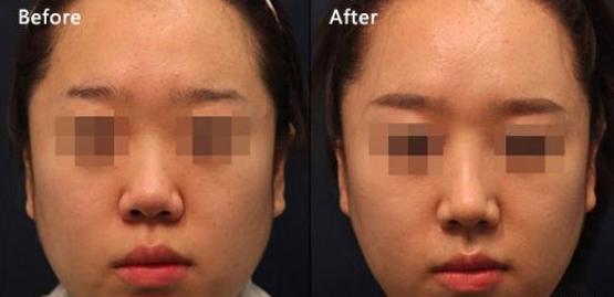 瘦脸针讲解视频,瘦脸针的原理与作用安全有效