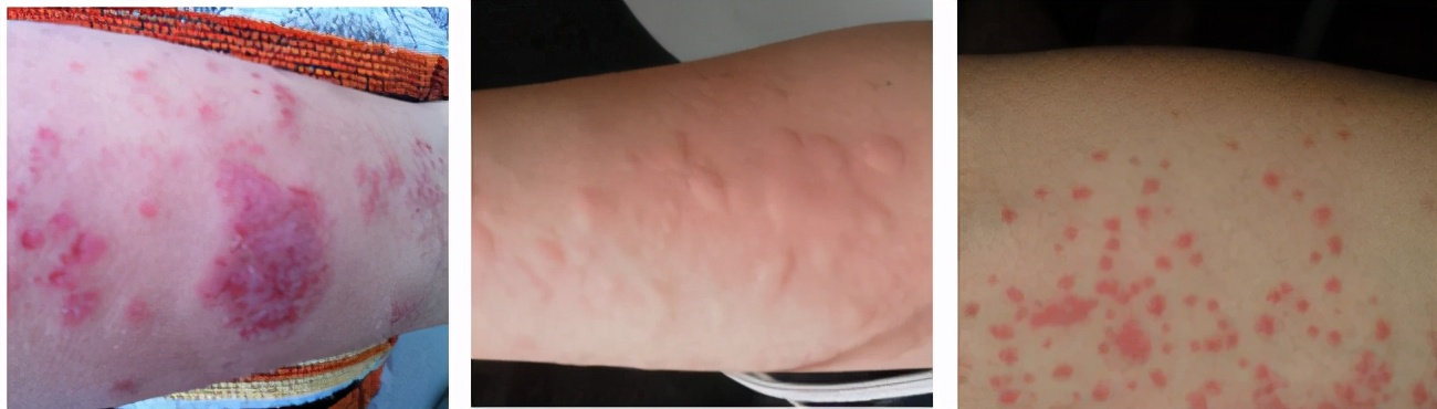 春天儿童疹子,春季儿童高发哪种疹子