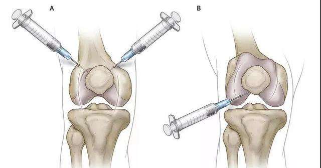 膝盖滑膜炎遇冷就痛,膝盖滑膜炎疼最快缓解方法小妙招