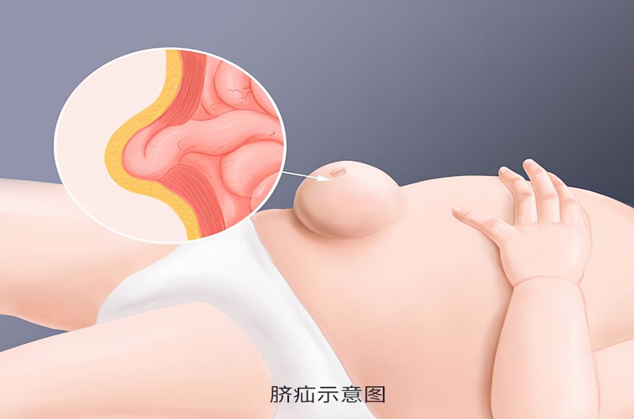 小儿疝气一般怎么引起的,小儿疝气怎么缓解