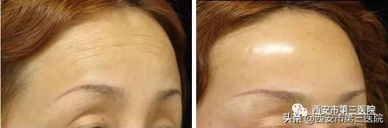 肉毒素能美白皮肤吗,肉毒素在医学美容的作用