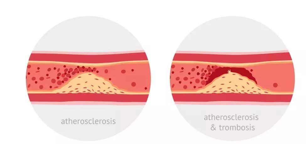 发无名火、中年阳痿、腿部痉挛......当心！也许是这种病惹的祸