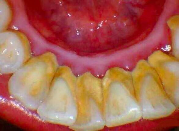 为啥中国人总是老掉牙,为什么中国人牙齿总掉光