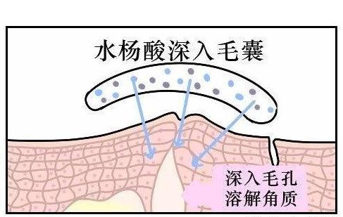 皮肤毛孔挤出黑的固体,皮肤干燥毛孔粗大该怎么解决