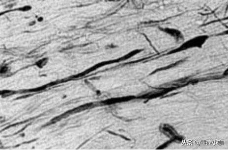 弥漫性轴索损伤和脑干挫伤,弥漫性轴索损伤有必要救吗