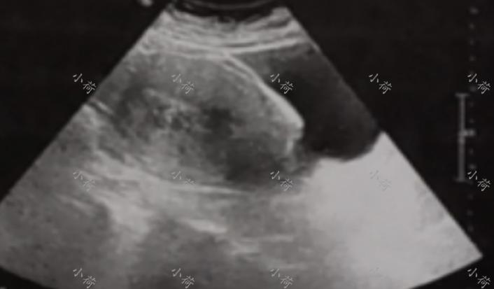 子宫内膜癌绝经后出血,绝经后的子宫内膜癌初期出血量