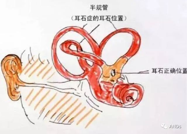六问法—良性阵发性位置性眩晕（BPPV）诊断