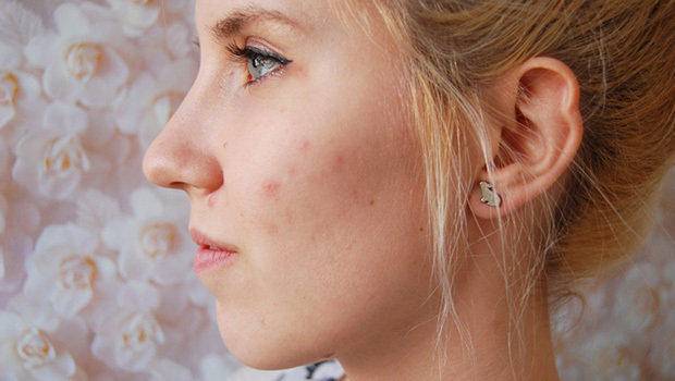 祛痘印不淡化黑色素,祛痘印长期不褪色