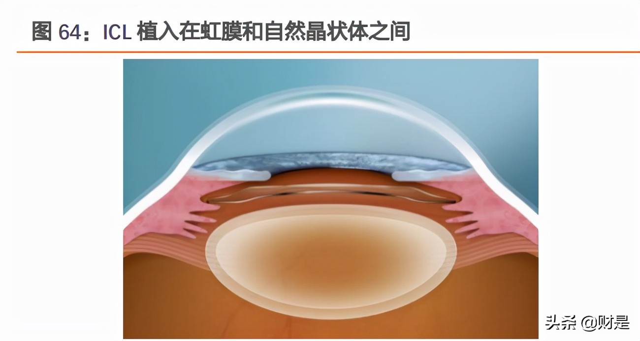 爱博医疗研报,爱博医疗最新资讯