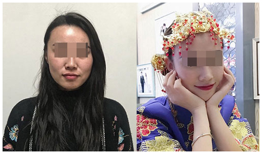 提升脸部下垂做什么项目好,皮肤下垂怎么办可以做面部提升吗