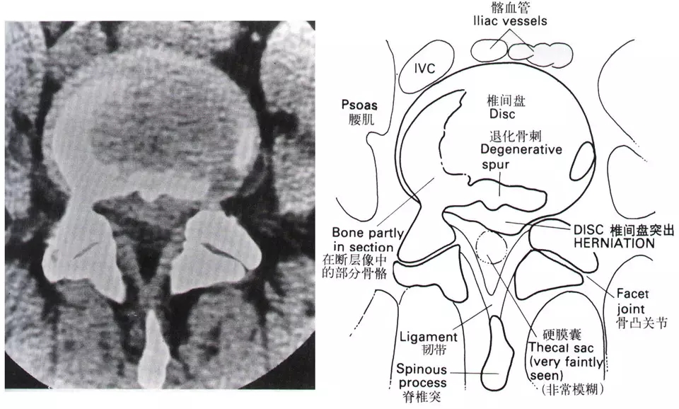 颈椎腰椎疾病ct及mri诊断,腰椎ct可以发现肠部病变吗