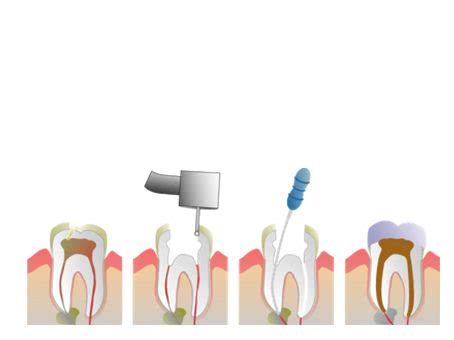 牙疼要做根管治疗会波及头疼吗,牙疼除了做根管治疗还能怎么办
