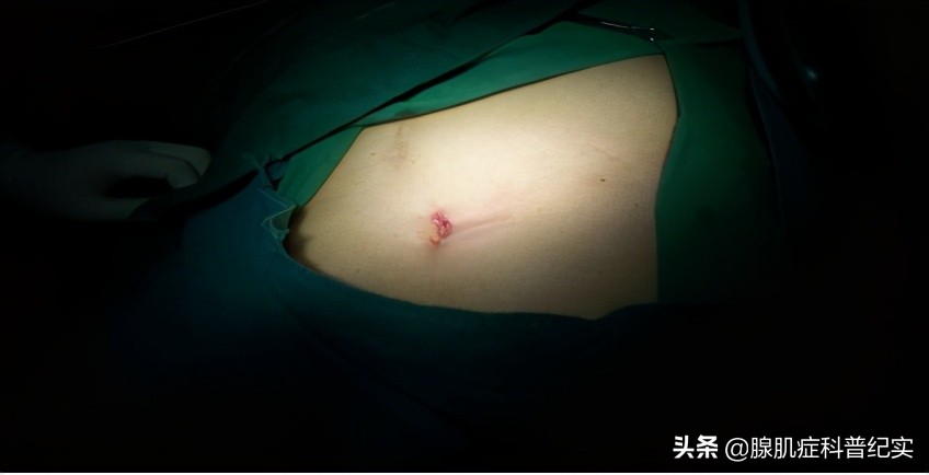 这4种手术治疗腺肌症的利弊你知道吗?