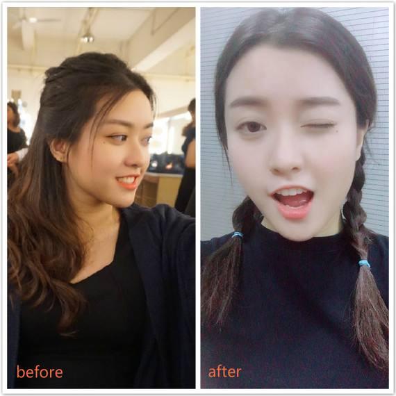 女人打美白针会变白吗,长期打美白针对身体有危害吗