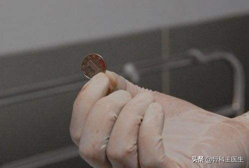 医院取出的异物怎么处理,医生都从患者体内取出过什么异物