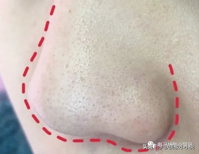 细化毛孔去黑头方法,三招DIY去黑头收毛孔