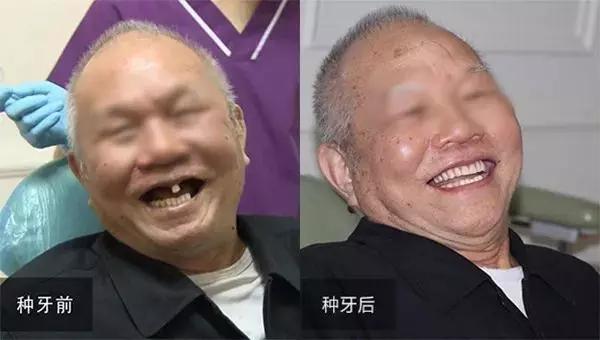 牙齿残根算牙齿缺失吗,口腔有缺失牙不处理好吗