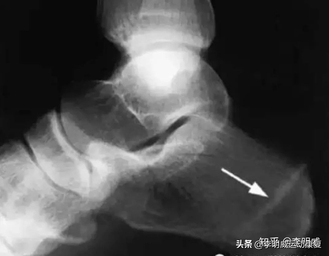 老年人足跟痛如何治疗,足跟痛的自我治疗方法