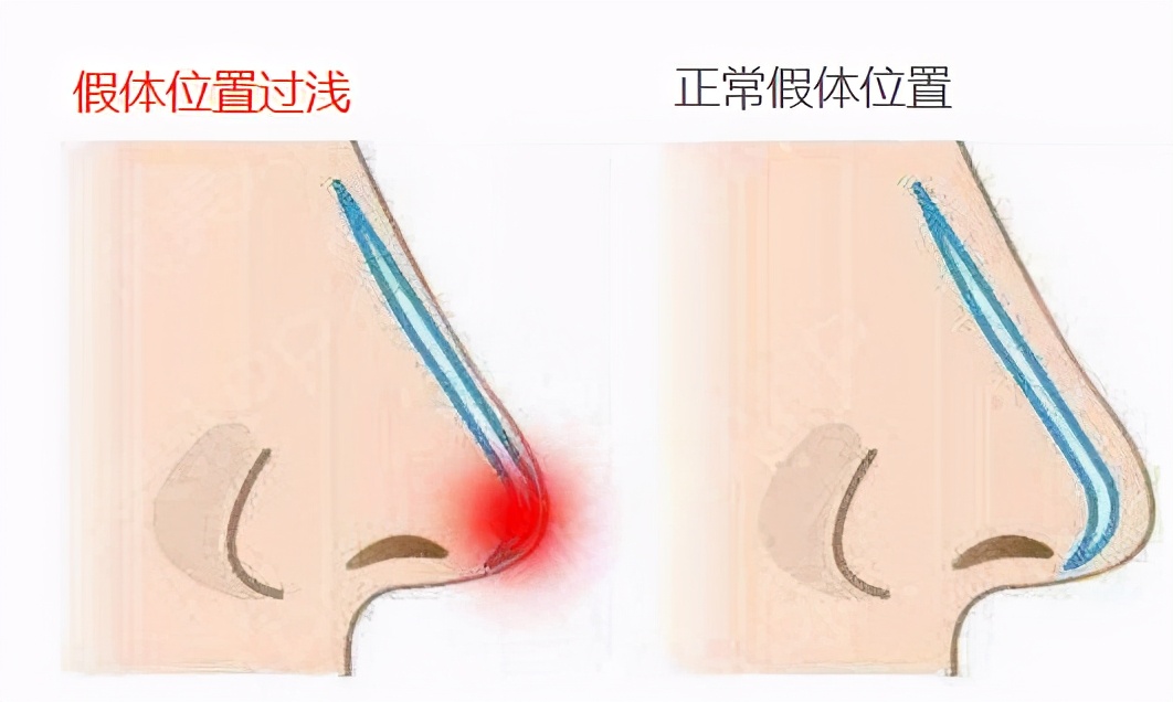 假体鼻整形手术全过程,鼻整形不满意多久可以取出假体