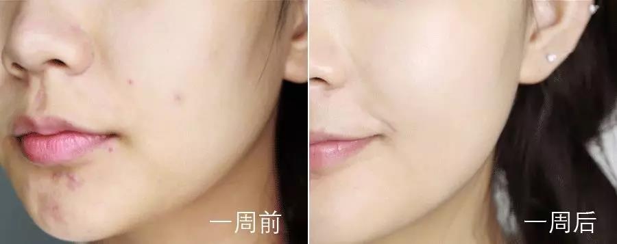 祛痘印最好的6个方法,祛痘印得最快的药膏