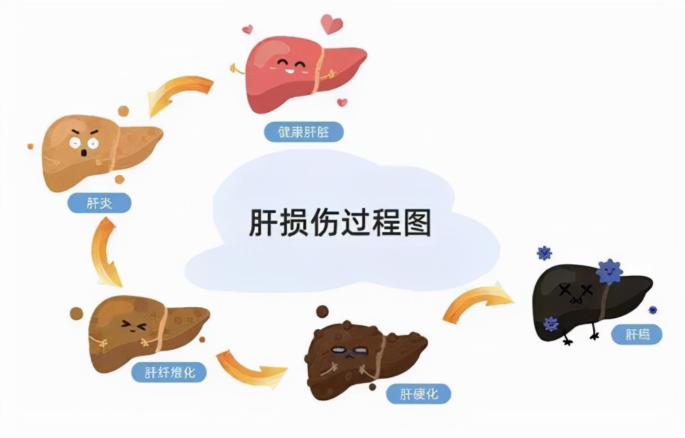 乙肝携带者肝硬化症状,乙肝患者十几年了一直没有治疗