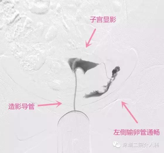 输卵管造影及再通术,输卵管造影要多少钱