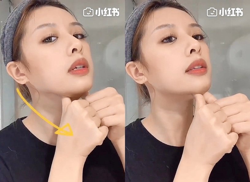 练精致下颚线,徐睿知脸部提升