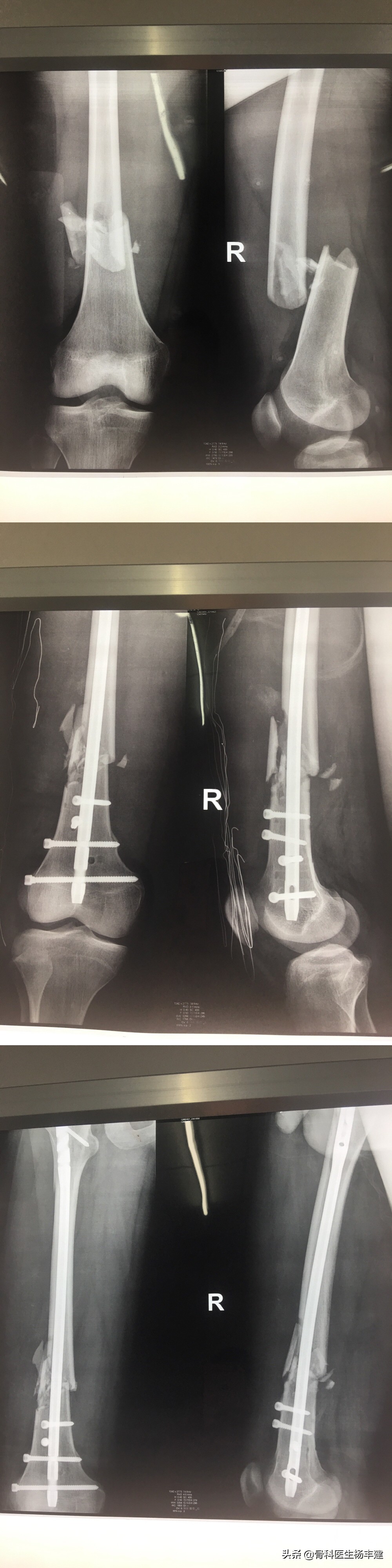 骨折保守治疗一定要手法复位吗,医生科普骨折的视频