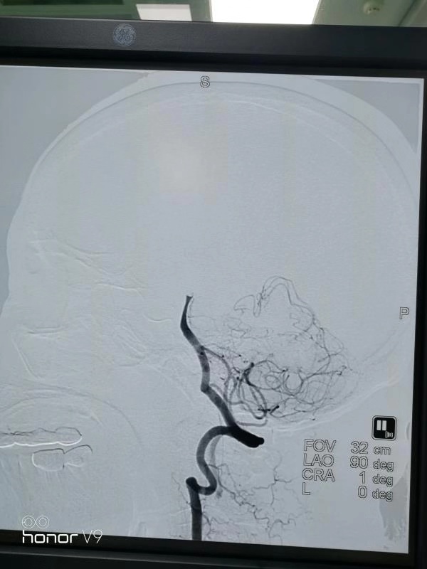 换瓣术后抗凝指南,换瓣术后抗凝不好有什么后果