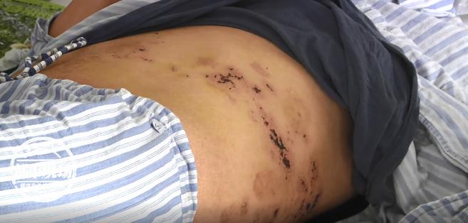 每年夏天左脚长水泡怎么回事,左腿突然长几个水泡怎么治疗