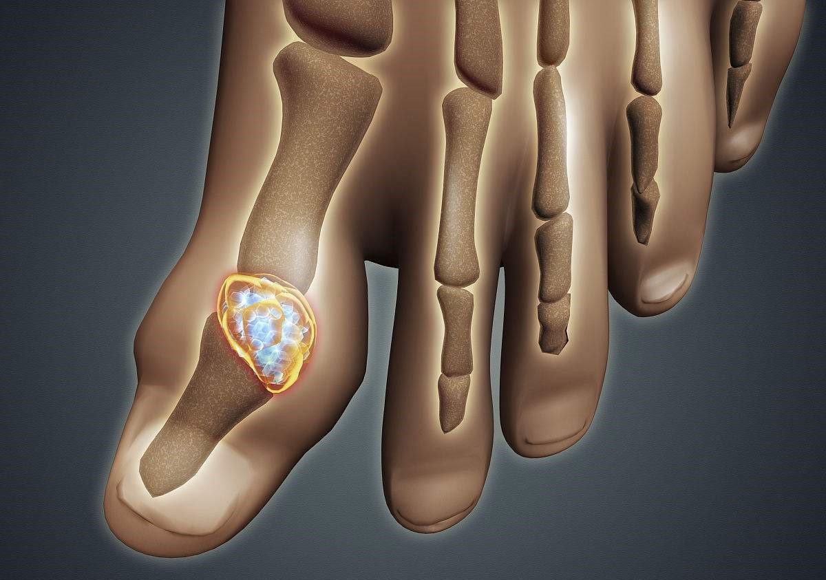 痛风看哪个科上哪个科室挂号,痛风造成膝盖有积液挂什么科室