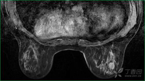 乳腺结节有消散的病例吗,一份完整的乳腺增生病例
