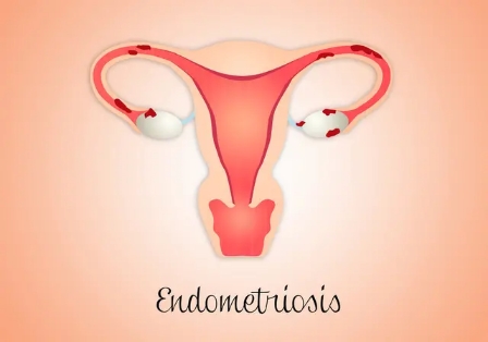 子宫息肉是常见妇科病吗,子宫息肉病因是什么