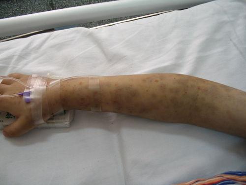 皮肤无缘无故出现青紫淤斑,身体突然出现青紫瘀斑