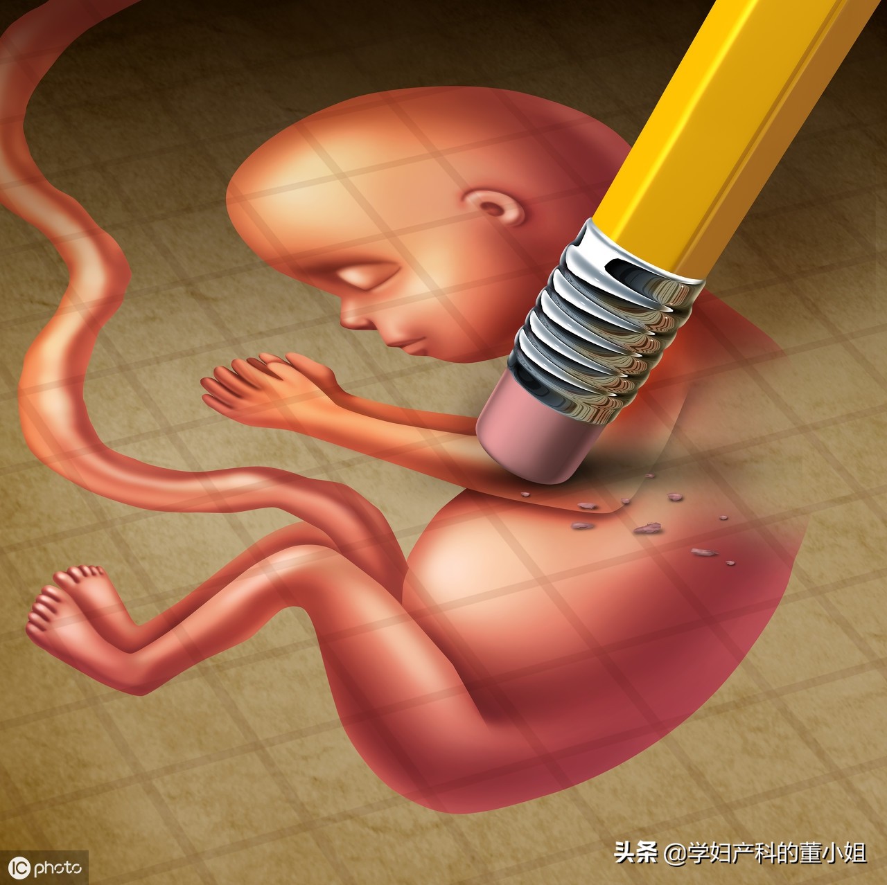 我怀孕了流产了,我怀孕了自己流掉了还需要清宫吗