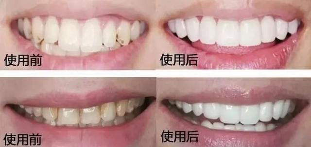 刷牙时一个小窍门彻底告别黄臭牙,刷牙的时候放点小苏打牙会变白吗