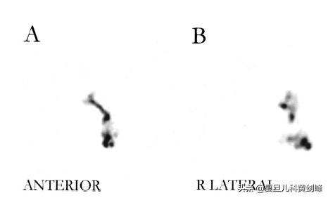 洗鼻子正确方式,孩子洗鼻子的正确方法视频