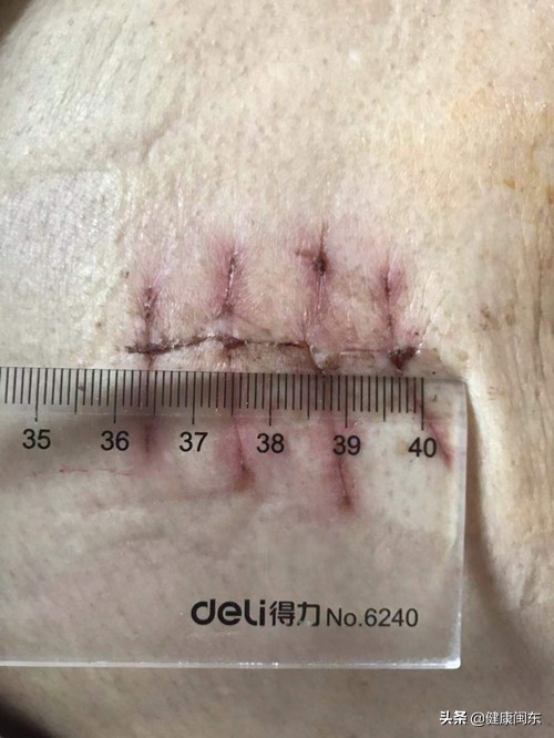 福建民间中医治疗肠癌,福建省立医院肠癌手术