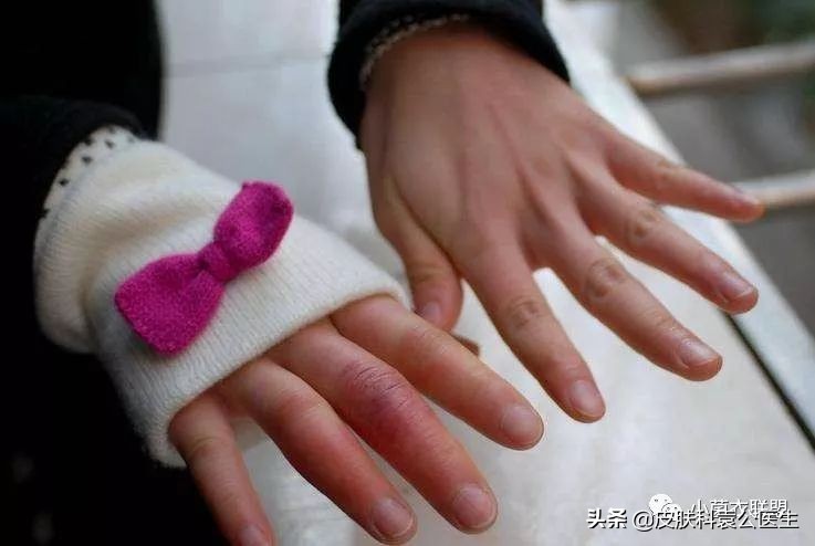 冻伤后痒痒是怎么回事,冻伤瘙痒