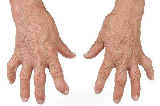 类风湿从早期到病重一般需要几年,类风湿严重如何治疗