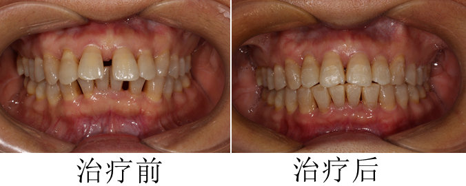 牙周炎能矫正牙齿吗,牙周炎还可以矫正吗