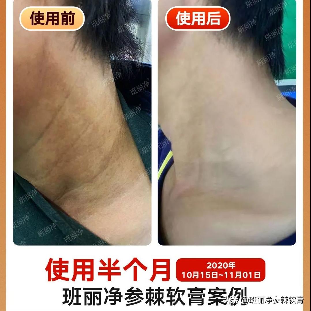 现在很多人都在祛斑靠谱吗,到底祛斑是真的还是假的