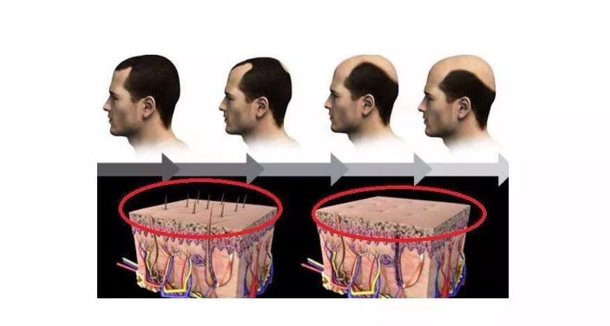 脱发严重用什么方法头发再次生长,初中生脱发严重怎么生发